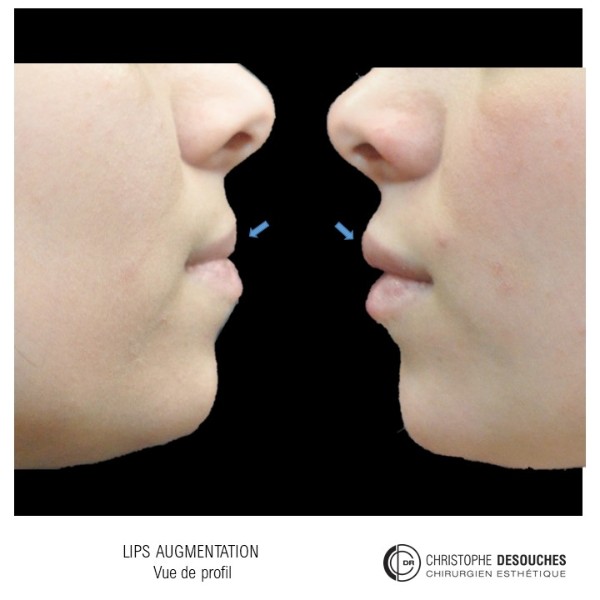 Lips increase