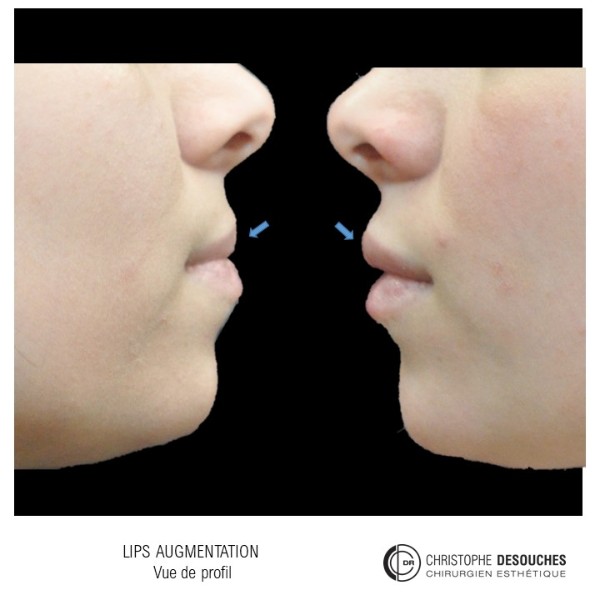 Lips augmentation