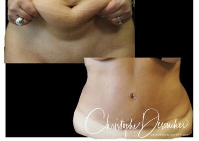 Lipectomia y liposuccion
