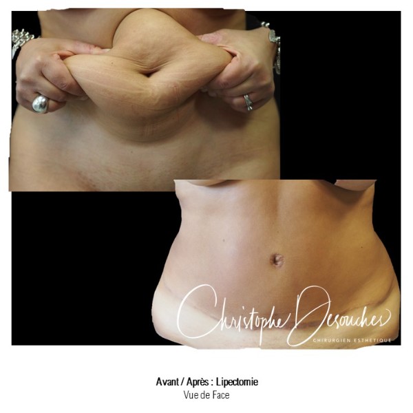 Lipectomy & liposuction