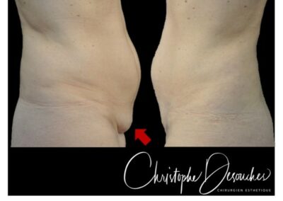 Mini lipectomia y liposuccion