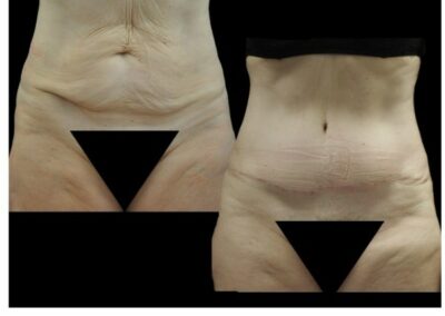 Lipectomia abdominal combinada con liposuccion