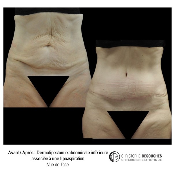 Abdominal lipectomy associated with liposuction