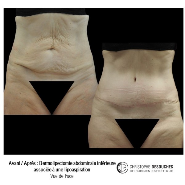 Lipectomia abdominal combinada con liposuccion