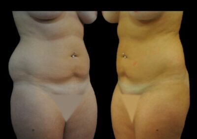 LIPOSUCCIÓN ABDOMINAL