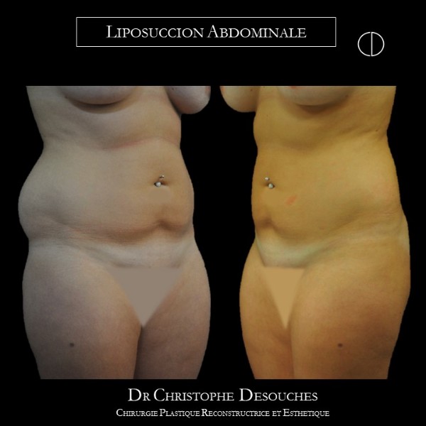 LIPOSUCCION ABDOMINALE