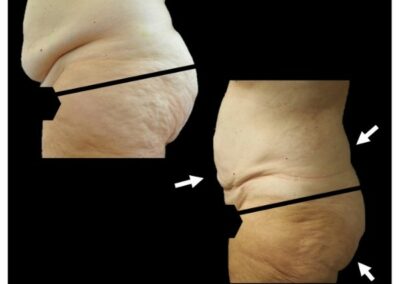 Liposucción de abdomen, caderas y alforjas