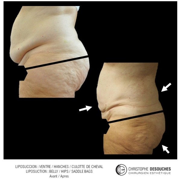 Liposuccion de l’abdomen, des hanches et de la culotte de cheval