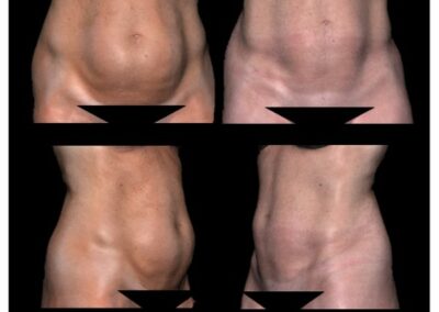 Liposucción de abdomen y caderas
