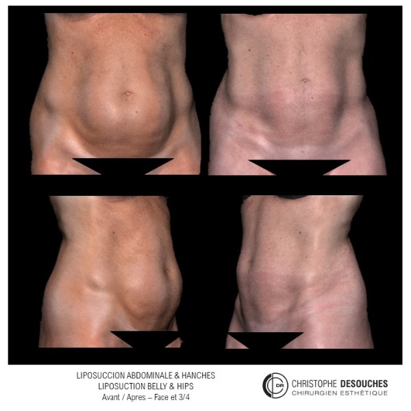 Liposuction of the abdomen and hips