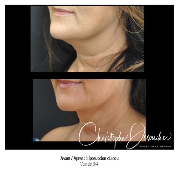 Neck liposuction