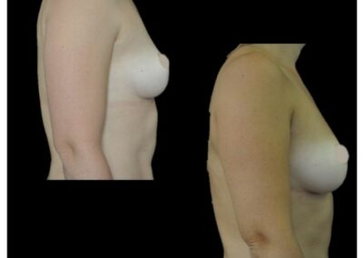 Aumento de senos mediante lipofilling