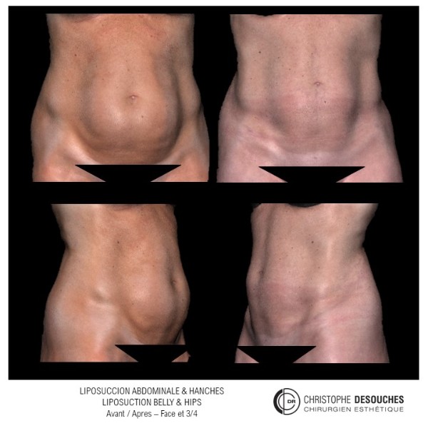 Liposuccion de l&rsquo;abdomen et des hanches avant après