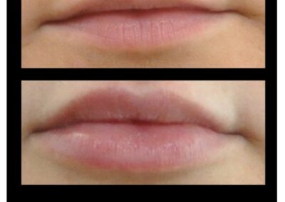 Aumento delle labbra mediante iniezione di acido ialuronico