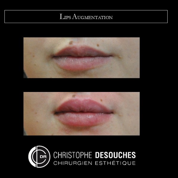 Lips augmentation, plumped lips, hyaluronic acid, redesigned hemming