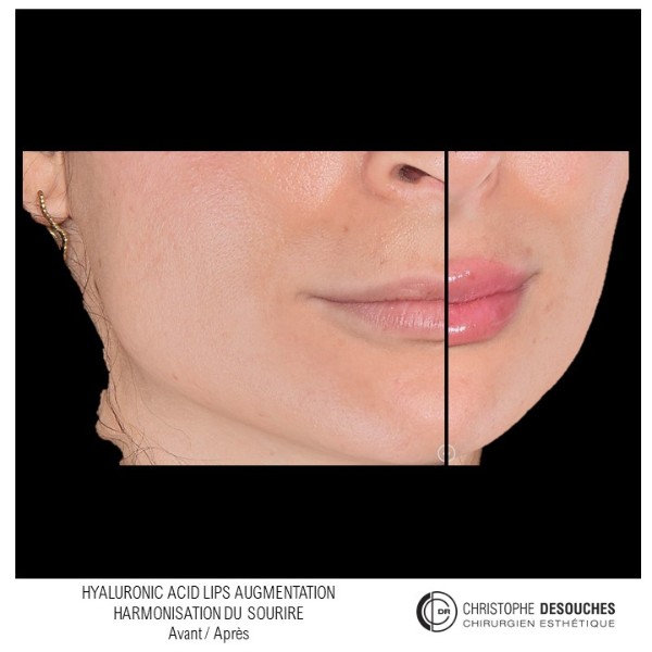 Increase in lip volume by injection of Hyaluronic Acid