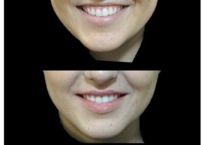 Armonizzazione del sorriso mediante iniezione di acido ialuronico sulle labbra