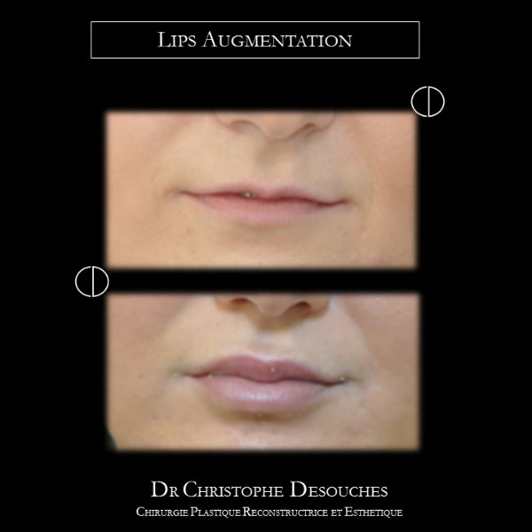 lip augmentation