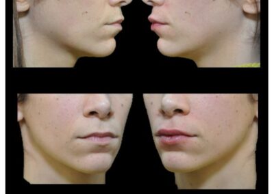 Hyaluronic acid lips augmentation - Lip augmentation