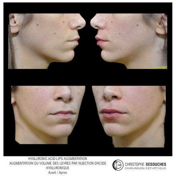 Aumento de labios con ácido hialurónico – Aumento de labios