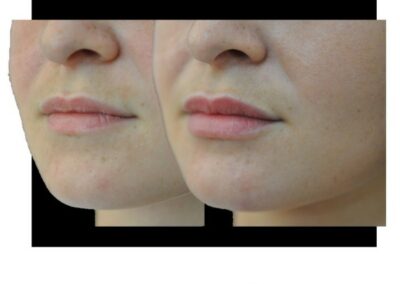 Aumento de labios / aumento de labios mediante inyección de ácido hialurónico