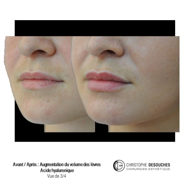 Lip augmentation / lip augmentation by injection of hyaluronic acid