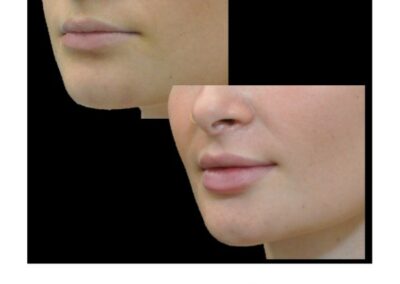 Plump and reshape the lips with hyaluronic acid