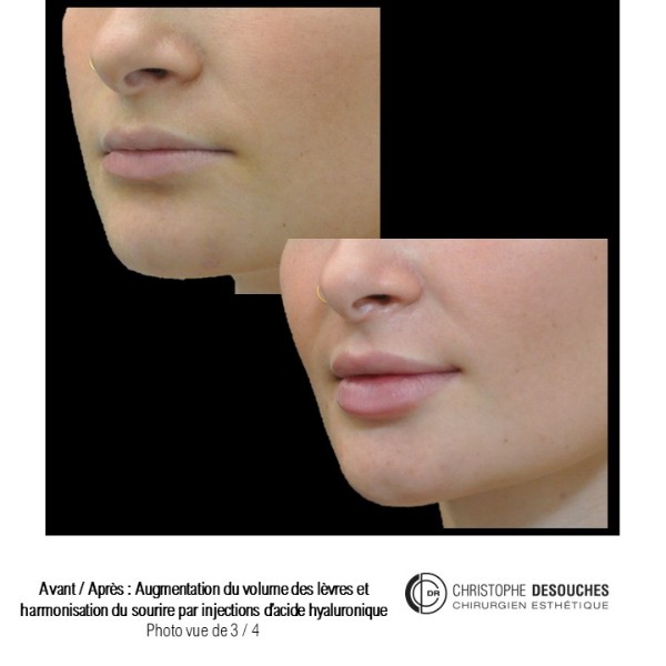 Plump and reshape the lips with hyaluronic acid