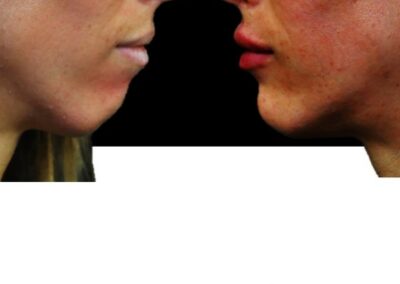 تقويم الوجه الطبي: تكبير الشفة والذقن 