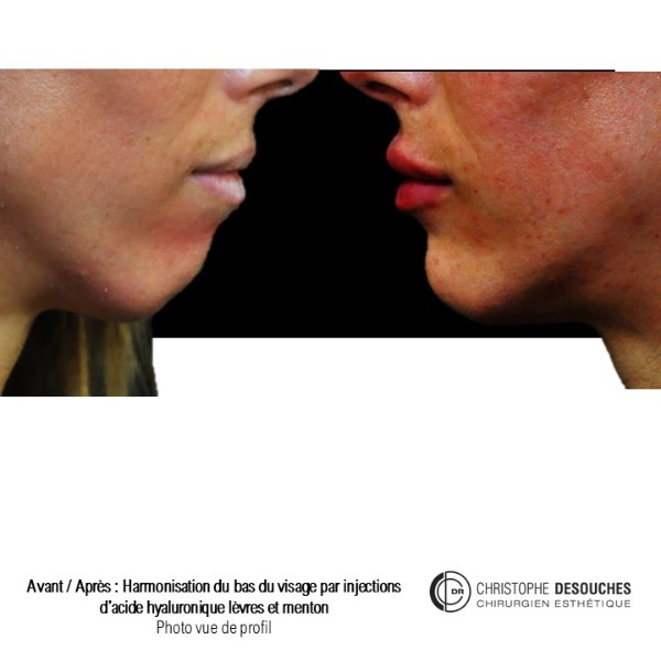 Medical profiloplasty: Lip and chin augmentation 