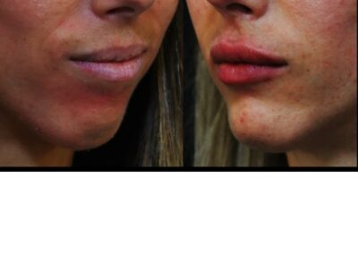 Médicale profiloplastie : Augmentation des lèvres et du menton 