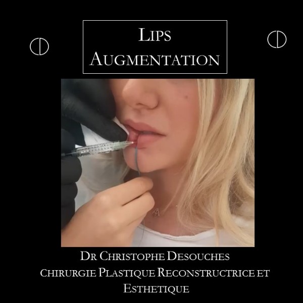 Lips augmentation