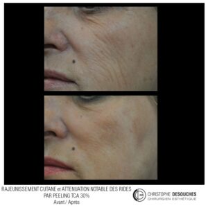 Avant/après peeling moyen au TCA, vue de 3/4 – Dr Desouches, Marseille