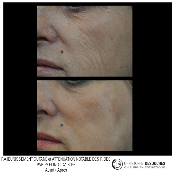 Peeling moyen