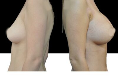 Aumento de senos con prótesis