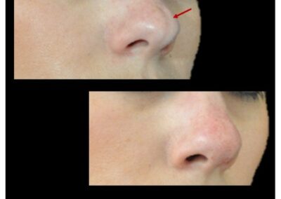 Harmonisation de la pointe du nez par injections d’acide hyaluronique