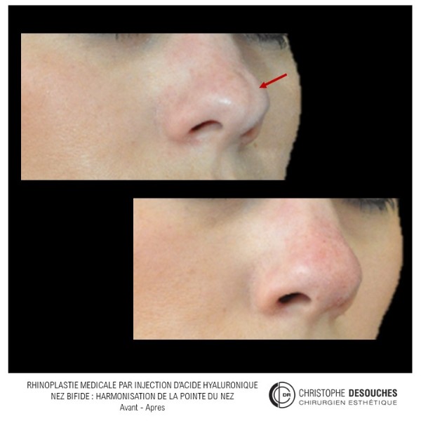 Harmonization of the tip of the nose by injections of hyaluronic acid