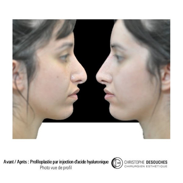 Rhinoplastie médicale : injections d’acide hyaluronique pour corriger le profil nasal