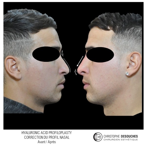 RHINOPLASTIE MÉDICALE POUR HOMME