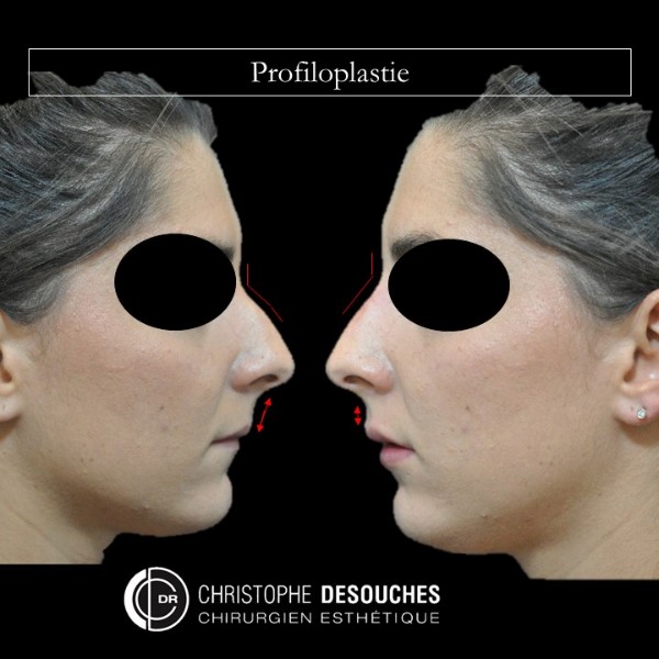 Profiloplastie par injection d’acide hyaluronique