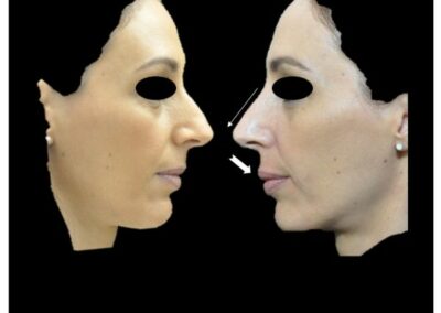 تجميل الوجه فن تنسيق الوجه عن طريق حقن حمض الهيالورونيك