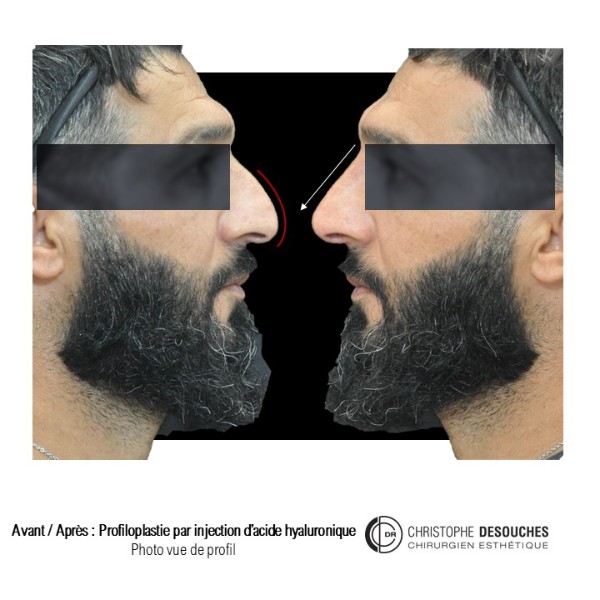 Rhinoplasty medical: injection of hyaluronic acid in the nose