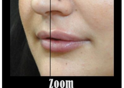 Augmentation du volume des lèvres par injection d’acide hyaluronique