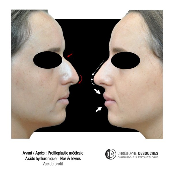 Harmonization of the nose and smile by injection of hyaluronic acid