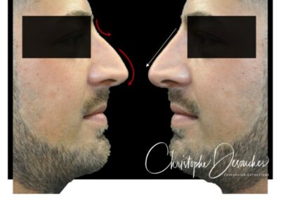 Medical rhinoplasty in humans - injection of hyaluronic acid