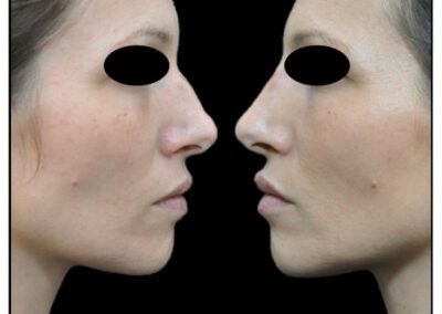 Abbellire il profilo senza intervento chirurgico – Profiloplastica Medica