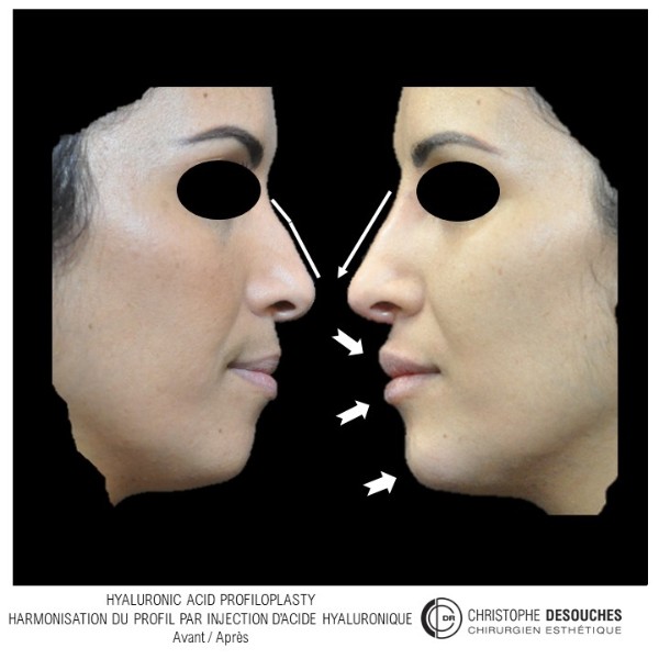 Medical profiloplasty: the art of harmonizing the profile without resorting to surgery