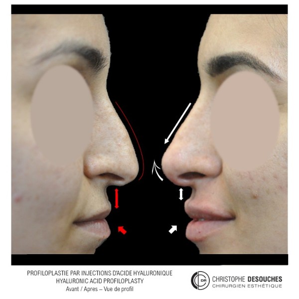 Rhinoplastie de la pointe associée a des produits de comblements