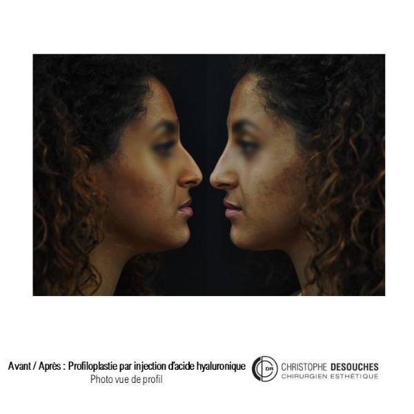 Profiloplastie par injection d&rsquo;acide hyaluronique