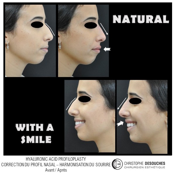 Injections d&rsquo;acide hyaluronique pour harmoniser le profil